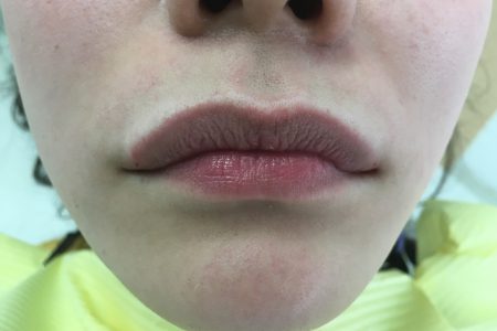 口元のアンチエイジング💋