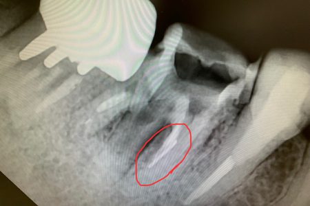 根管内異物除去のケース