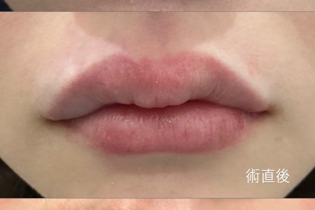 ヒアルロン酸👄